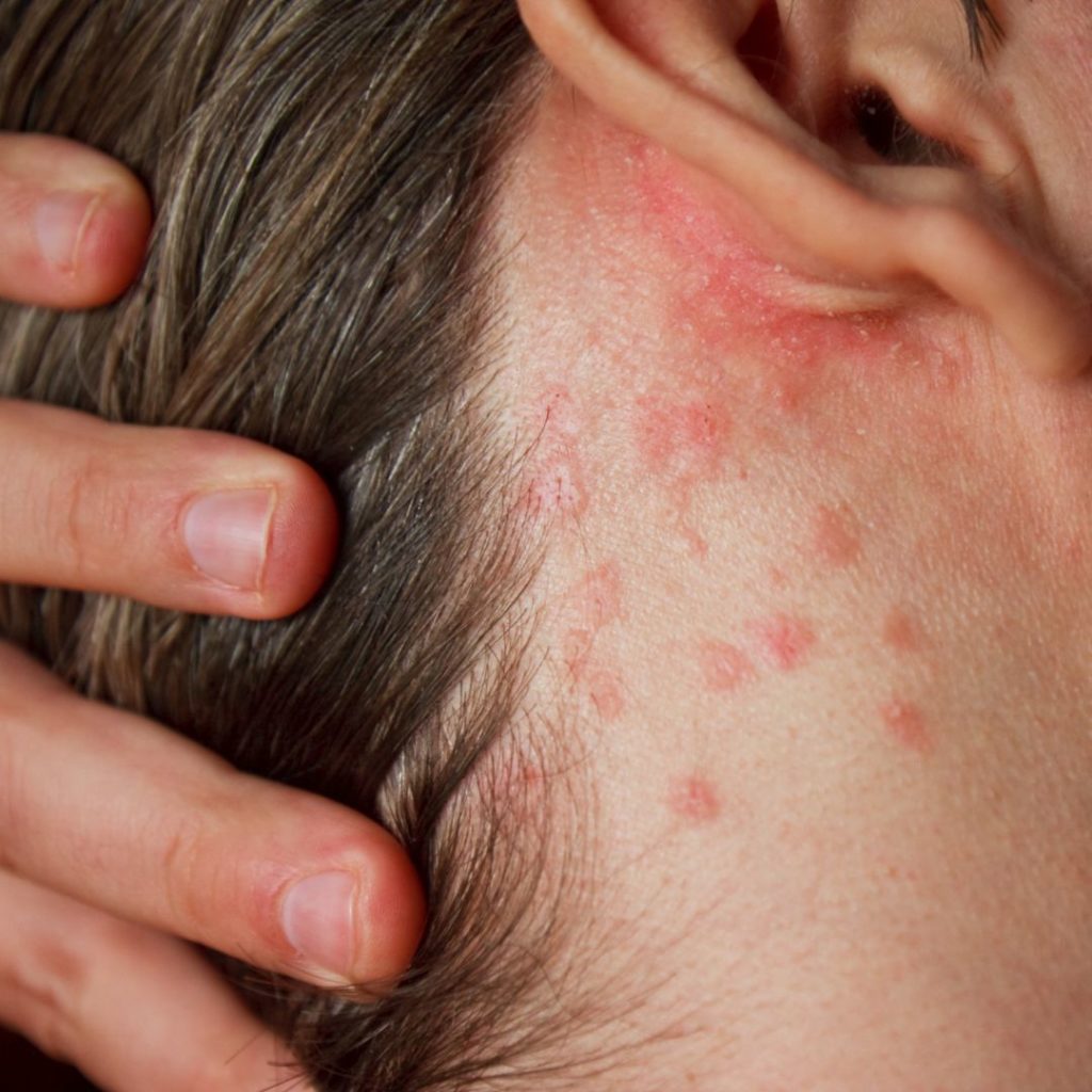 What triggers a shingles outbreak Plantation Dermatology K9hNOy9BwAyIrM